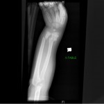 4-year-old-both-bone-forearm-break-AP-xray fractured pediatric distal radius