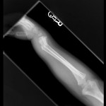 4-year-old-male-both-bone-forearm-fracture lateral view pediatric distal radius and ulna fracture