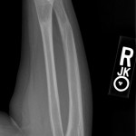 6 month follow up both bone forearm fracture callus formation both bone pediatric fracture xray