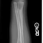 6 month pedatric both bone fracture remodeled pediatric both bone forearm fracture healed