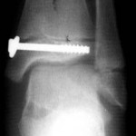 ankle_ap xray of the ankle after fixation