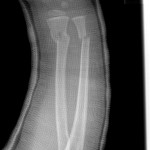 both bone fracture 1st cast pediatric distal radius and ulna cast