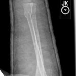both bone fracture 1st cast lat pediatric distal radius and ulna lateral xray
