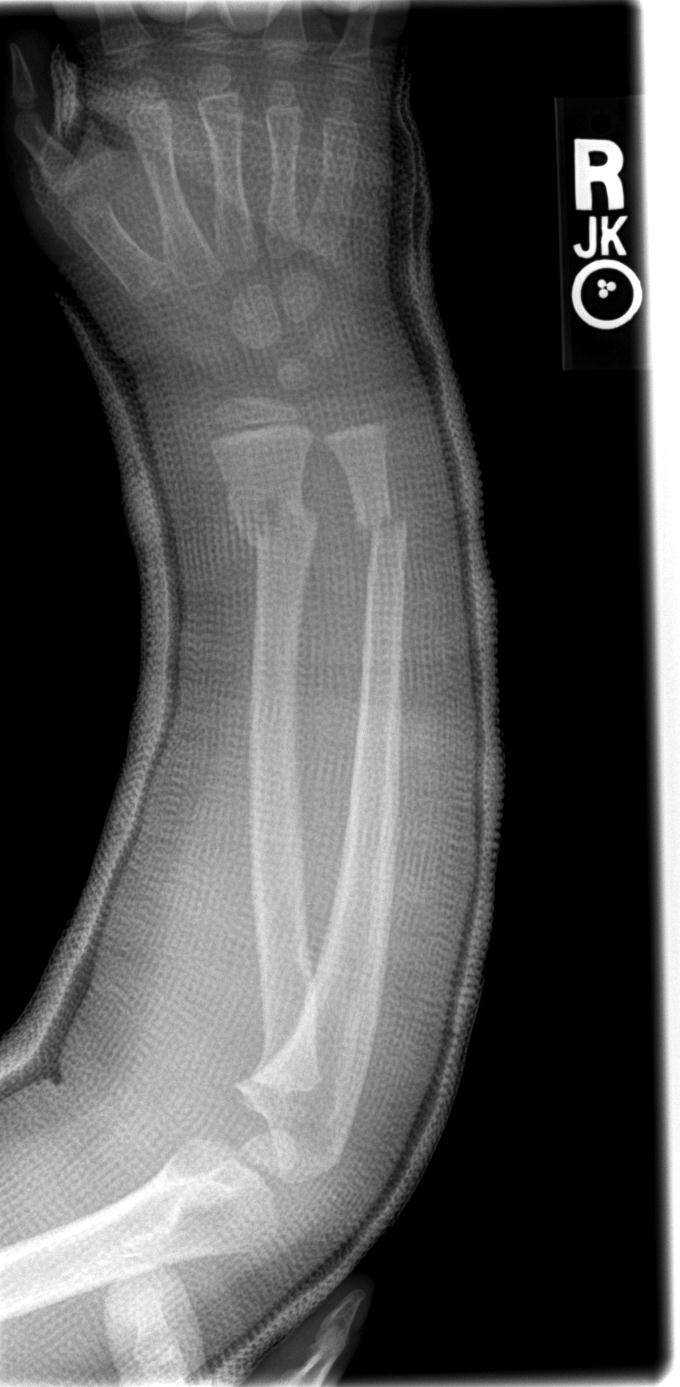 Common forearm fractures in children » Forearm Fracture | Greenstick