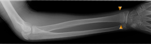 colles 1 distal radius fracture AP view