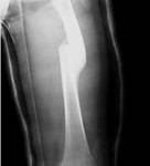 femur_spica_1 fractured femur treated in a spica cast
