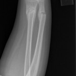 four year old both bone fracture after cast removal