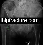 hip fracture surgery