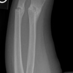 pediatric both bone fracture after casting callus formation both bone pediatric fracture