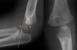 supracondylar 1 supracondylar fracture of the humerus