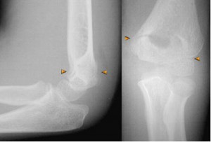 supracondylar 2 supracondylar fracture of the elbow