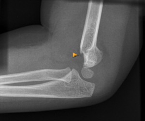 supracondylar 3 Type 2 supracondylar elbow fracture