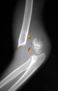 supracondylar 4 Type 3 supracondylar elbow fracture