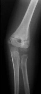 supracondylar fracture after pin removal supracondylar fracture after pin removal