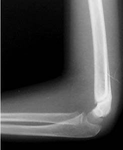 supracondylar fracture after pin removal supracondylar fracture after pin removal
