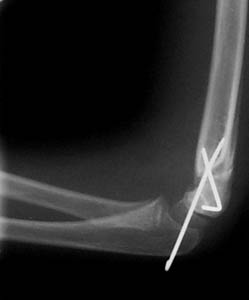 supracondylar pinning 1 supracondylar pinning 1