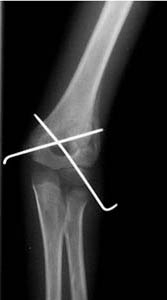 supracondylar pins 2 percutaneous pinning of a supracondylar elbow fracture