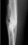 partially healed partially healed tibia fracture