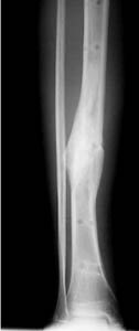 tibia_exfix_healing_2 external fixator removed, healed tibia fracture