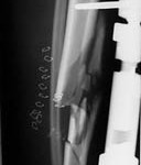 tibia ex fix injury 1 external fixator applied to a tibia fracture