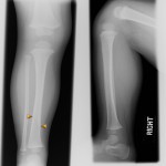 Toddler's fracture oblique fracture of the distal tibia in a toddler