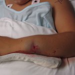 both-bone-forearm01 pediatric fracture