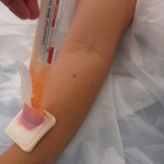 both bone forearm03 pediatric fracture treatment