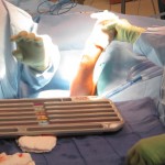 both bone forearm06 synthes flexible nail pediatric fracture