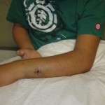 both bone1 fracture radius