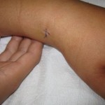 both bone2 flexible pediatric nail
