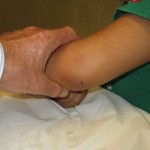 both bone3 pediatric arm fracture