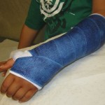 both bone4 greenstick fractures