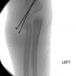 elbow-fracture-pinning