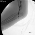 elbow-fracture-pins elbow-fracture-pins