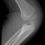lateral-elbow-fracture lateral-elbow-fracture