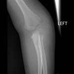 lateral-epicondyle-fracture