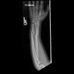 open pediatric forearm fracture open both bone forearm fracture