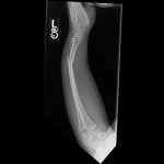 open radius and ulna fracture open both bone forearm fracture xray